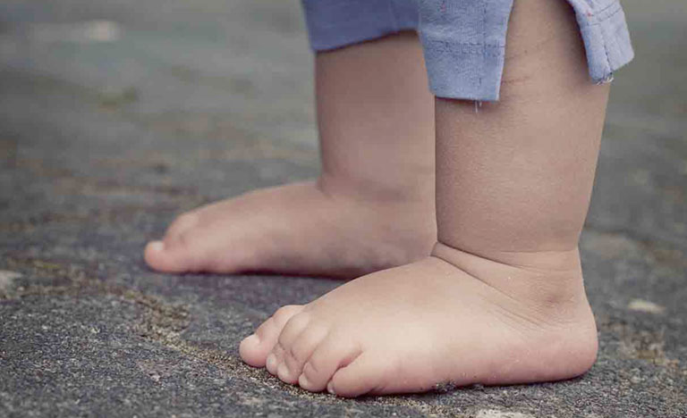 Bàn chân bẹt ở trẻ em