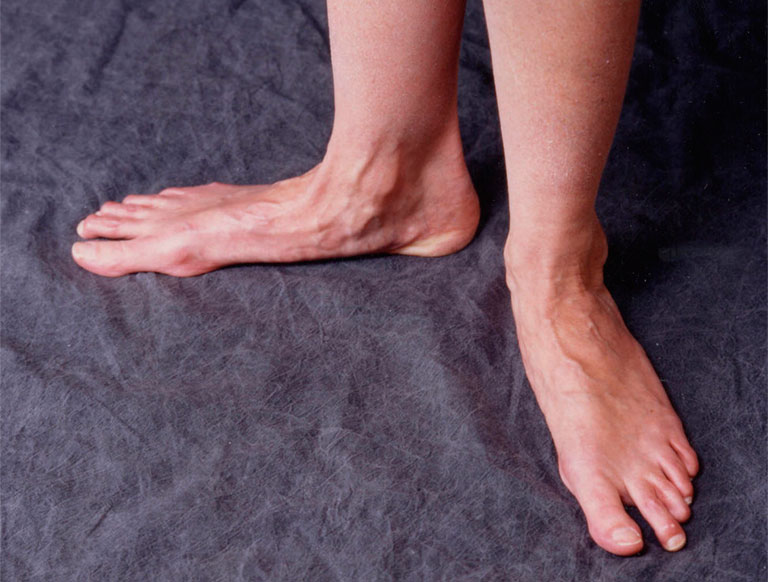 Hậu quả của bàn chân bẹt