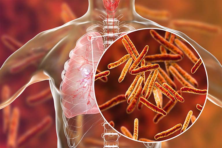 Bệnh Lao cột sống xảy ra do sự xâm nhập của vi khuẩn lao Mycobacterium tuberculosis