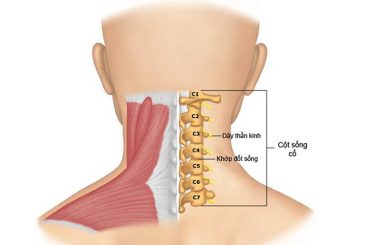 Thông tin cơ bản về bệnh thoái hóa cột sống cổ, triệu chứng, nguyên nhân gây bệnh và cách điều trị