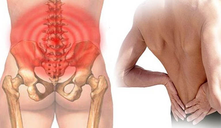 Thoái hóa cột sống thắt lưng làm ảnh hưởng đến phần lưng dưới, gây đau và cứng khớp