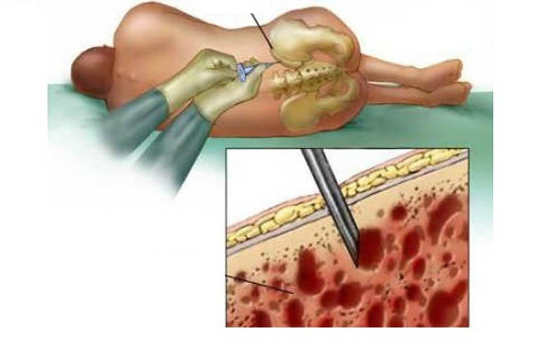 Chọc dò có thể thấy mủ