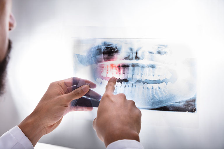 Chụp X-quang xương và răng