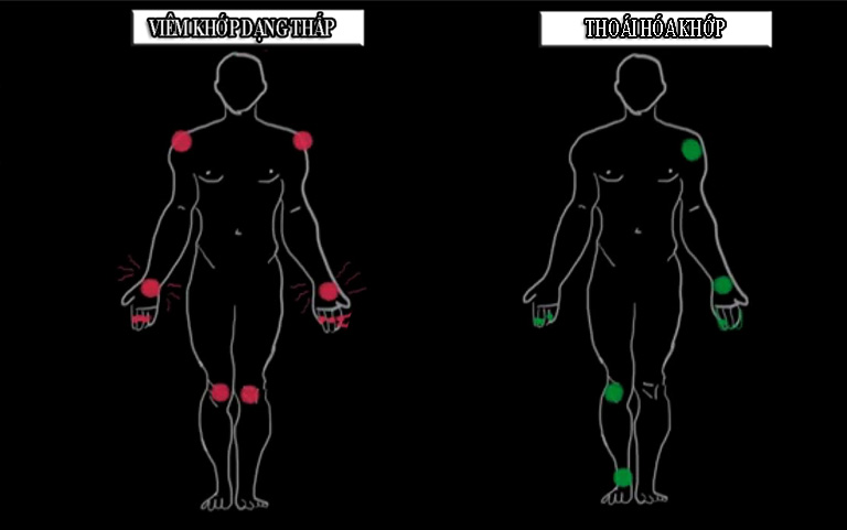 phân biệt thoái hóa khớp và viêm khớp dạng thấp