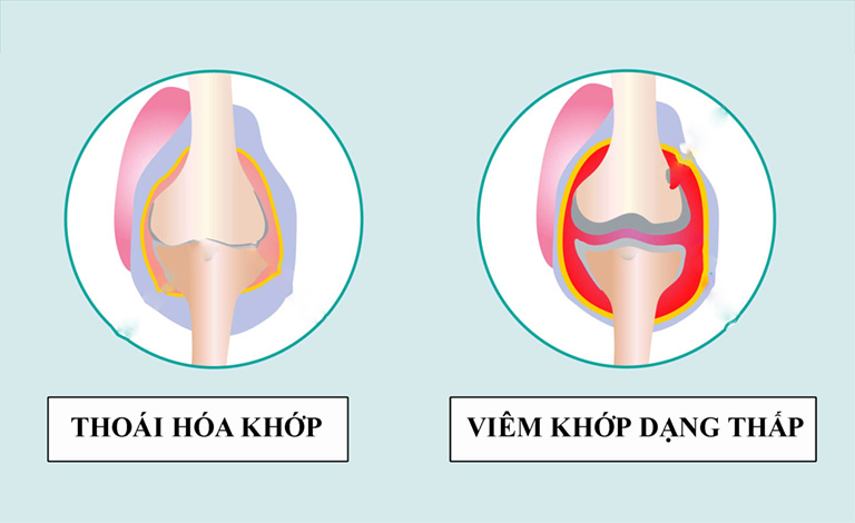 phân biệt viêm khớp dạng thấp và thoái hóa khớp