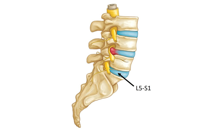 Thoát vị đĩa đệm cột sống thắt lưng L5 S1 là một vấn đề phổ biến