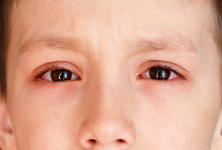Viêm mắt, viêm màng bồ đào, viêm mống mắt là những biến chứng thường gặp ở trẻ em bị viêm khớp dạng thấp