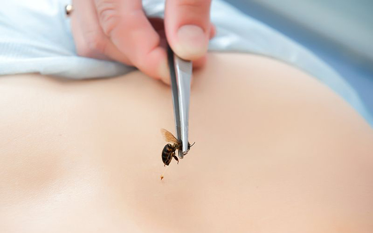 Điều trị viêm khớp dạng thấp bằng cách để ong đốt trực tiếp