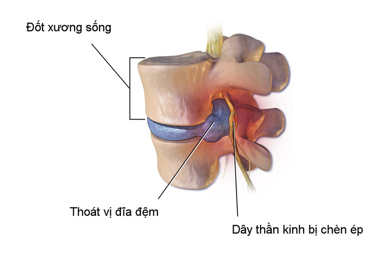 Thoát vị đĩa đệm cột sống cổ ngực