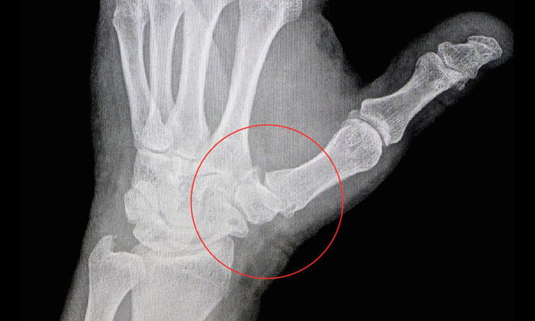 Thoái hóa khớp ngón tay, bàn tay xảy ra do các khớp bị hao mòn