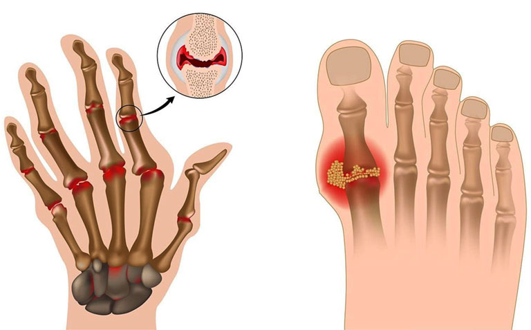 bệnh gout ăn cà chua không