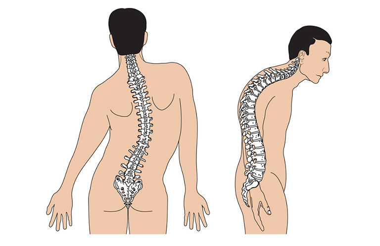 Biến dạng cột sống