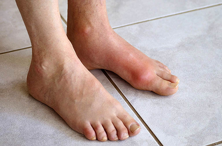 thuốc đông y chữa bệnh gout