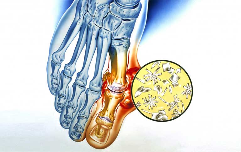 Các giai đoạn của bệnh gout 