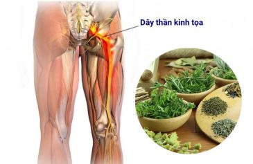 thuốc nam chữa đau thần kinh tọa