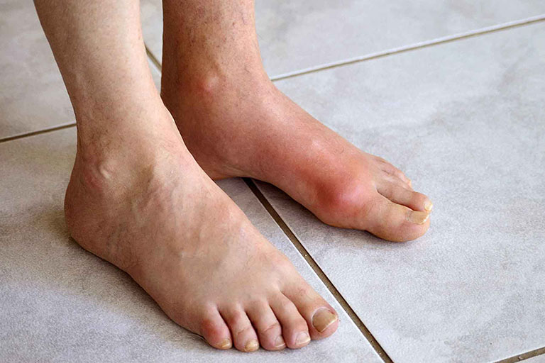 chữa bệnh gout bằng thuốc nam hiệu quả không