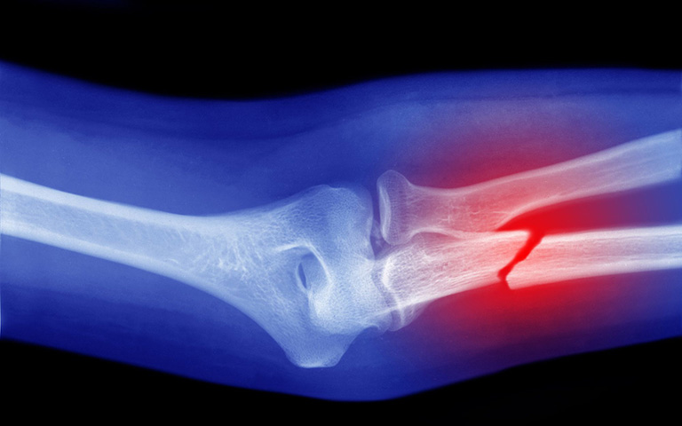 Gãy xương trụ có thể xảy ra khi té ngã dẫn đến chấn thương cẳng tay