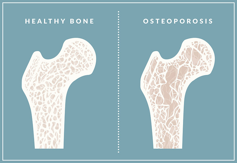Bệnh loãng xương khiến sức khỏe, mật độ xương và chức năng của xương trụ suy giảm