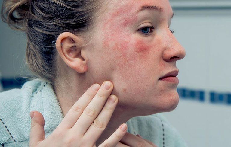 Bệnh lupus ban đỏ có chữa được không