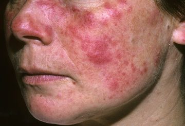 lupus ban đỏ giai đoạn cuối