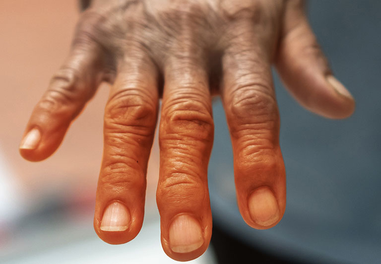 tê bàn tay là triệu chứng của bệnh gì