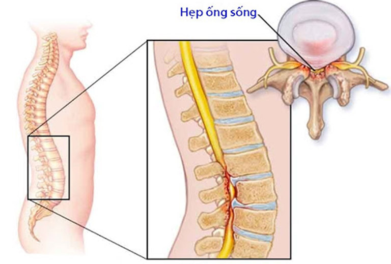 bệnh gây đau nhức xương khớp tê bì chân tay