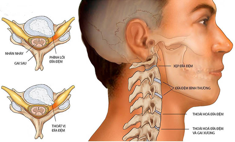 Đau sau gáy cổ thường xảy ra sau một tổn thương do thoát vị đĩa đệm cổ
