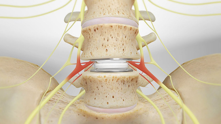 Cấy ghép đĩa đệm nhân tạo không phải là phương pháp chữa đau lưng