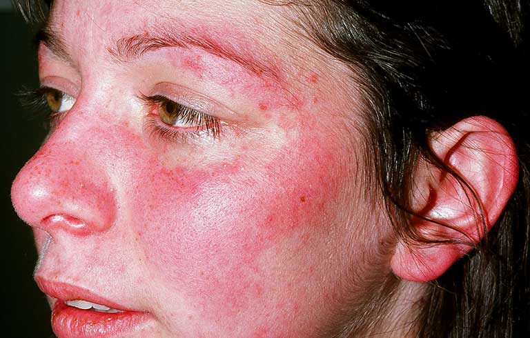 mắc bệnh lupus ban đỏ sống được bao lâu