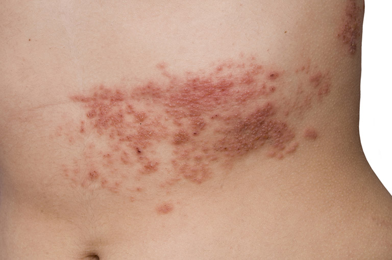 Nhiễm trùng herpes hoặc bệnh zona