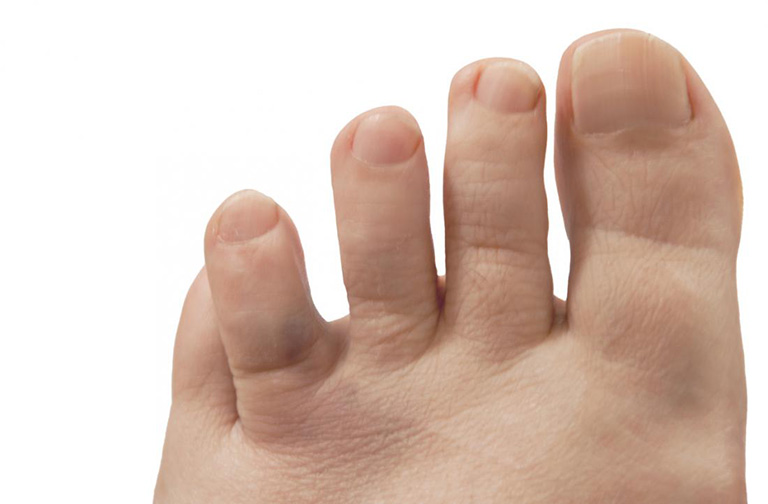 Đầu ngón chân bị đau như kim châm không được điều trị gây biến dạng khớp vĩnh viễn