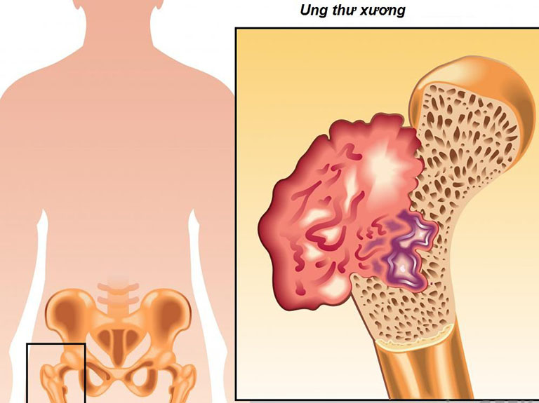Ung thư xương giai đoạn cuối là giai đoạn tiến triển nhất của bệnh