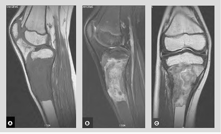 Chụp cộng hưởng từ (MRI)