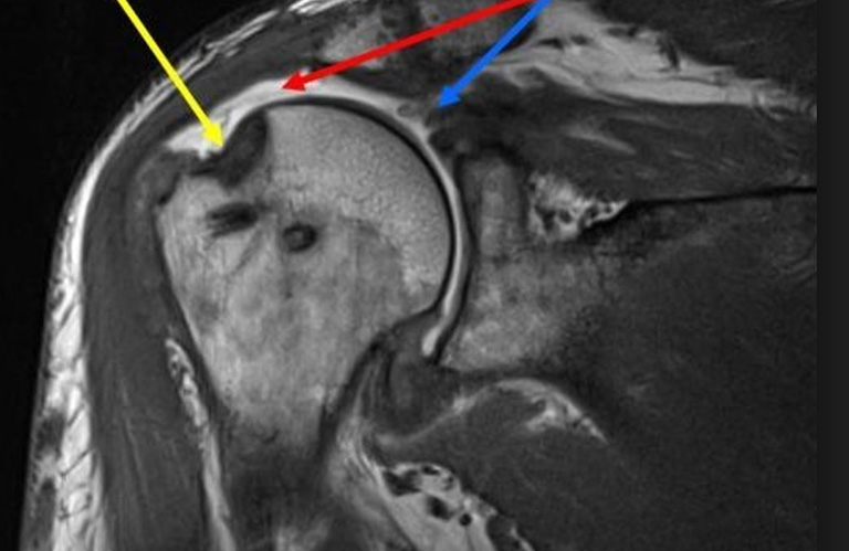 Chụp cộng hưởng từ (MRI)