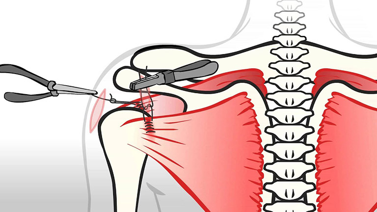 Điều trị phẫu thuật