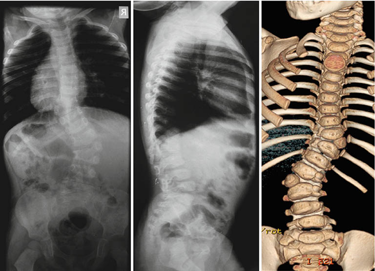 Các xương cột sống bất thường sẽ được thể hiện rõ nét trên hình ảnh X-quang