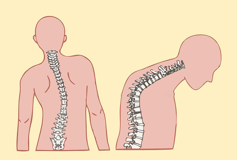 Phương pháp chữa vẹo cột sống bằng đông y