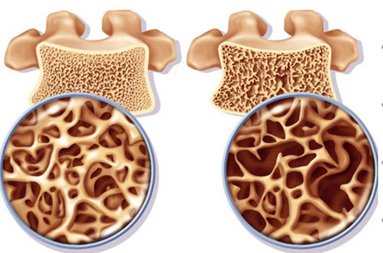 Công dụng của phương pháp DEXA và DXA