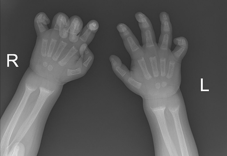 Hình ảnh X-quang có thể giúp xác định các dị tật của xương