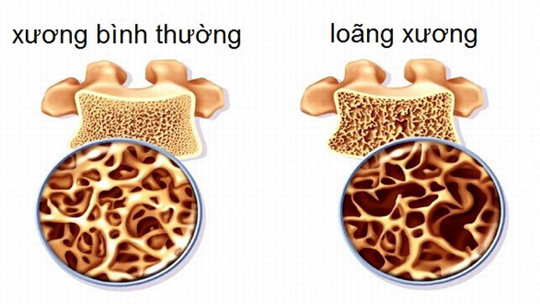 Thuốc Fosamax Plus được chỉ định để điều trị loãng xương