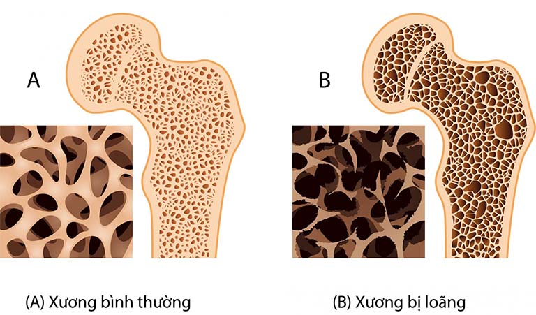 Thuốc tiêm trị loãng xương được chỉ định cho bệnh nhân bị loãng xương do suy tuyến sinh dục