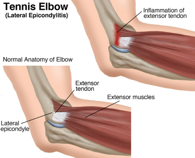 Тендиноз сухожилия что это. Латеральный эпикондилит сухожилие. Медиальный эпикондилит сухожилия. Эпикондилита локтевого сустава. Латеральный надмыщелок локтевого сустава.