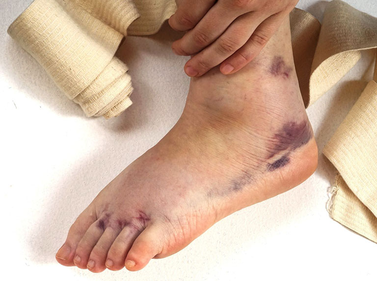 Mất từ 3 -12 tháng để cổ chân tổn thương phục hồi hoàn toàn