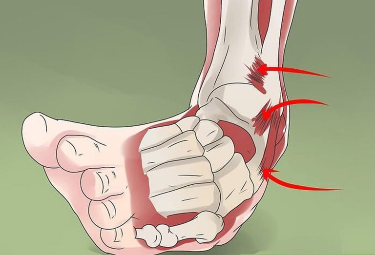 Phân loại trật mắt cá chân