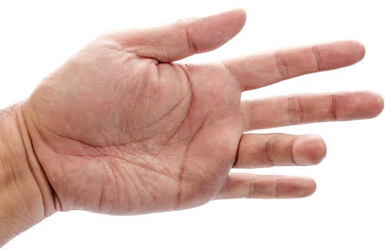 Viêm bao gân gấp ngón tay không được điều trị dẫn đến đứt/ rách gân, ngón tay bị biến dạng