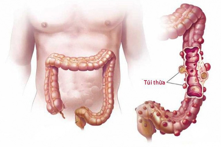 Viêm túi thừa