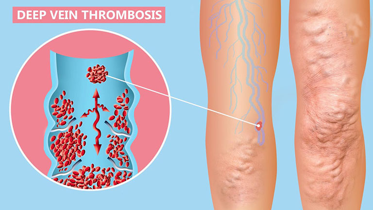 Huyết khối tĩnh mạch sâu (DVT)