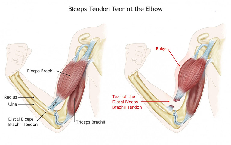 Đứt gân cơ nhị đầu ở khuỷu tay