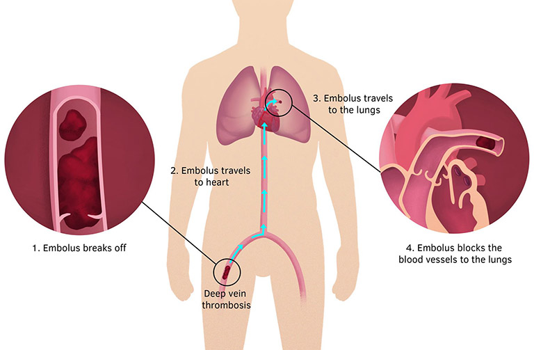 Thuyên tắc phổi