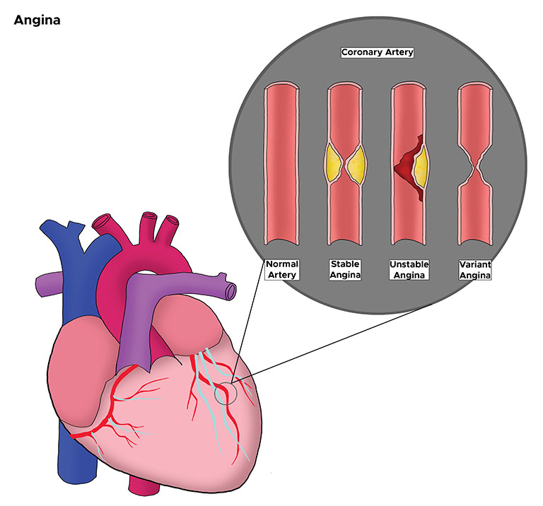 Cơ tim không nhận đủ lượng oxy cần thiết cho các hoạt động bình thường